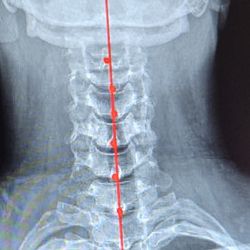 Natural Way Chiropractic - Xray of neck April 2024