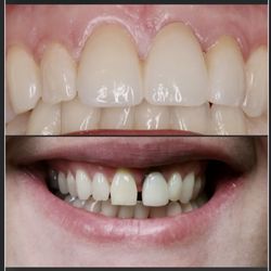 Willow Tree Dental, Christopher Seese - Before and after of tooth extraction and bridge placement.