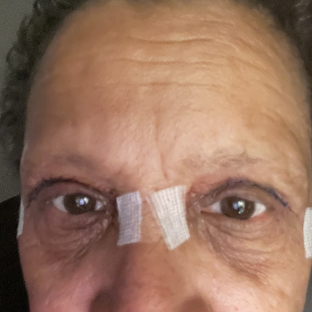 Iconic Plastic Surgery - 3 days post - Cosmetic Surgeons Near Me - Carlsbad, California
