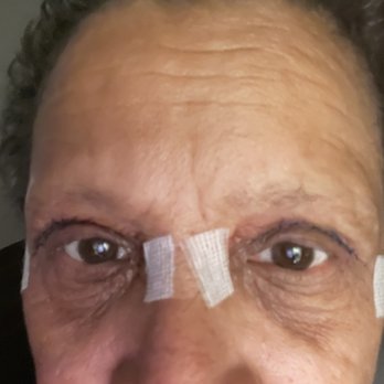 Iconic Plastic Surgery - 3 days post - Cosmetic Surgeons Near Me - Carlsbad, California