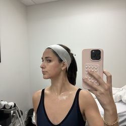 Cherry Hills Cryo - Cryo facial results