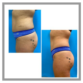 Laser Essentials Medical Spa - Exilis and emsculpt treatments don't to abdomen and butt. - Medical Spas Near Me - Plano, Texas