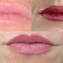 Upper left: Before picture Upper right: Right after lip service Lower: healed a few weeks
