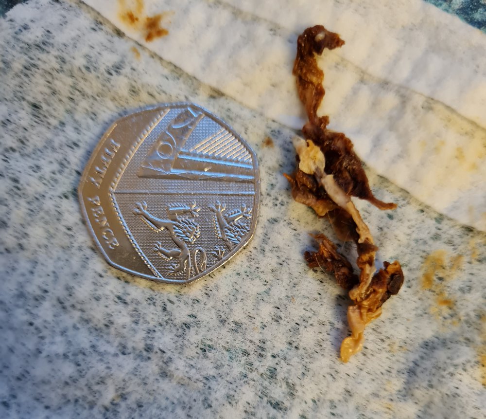 Ear Wax Removal Birmingham at Faye Salamone blog