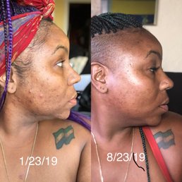 Left: first day of Jessner chemical peel January 23, 2019 .  Right: 7 months later