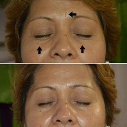 Skin Care by MJP - post lifting facial
