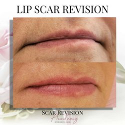 Victoria Knight Aesthetics - Lip Scar Revision and Repigmentation for this beauty who had an accident when she was younger.