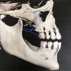 Jeremy L Johnson, DDS - Monroe Smiles - My fractured ridgeline and shards of jaw that needed reparative surgery after Dr Padillas care of my mouth.