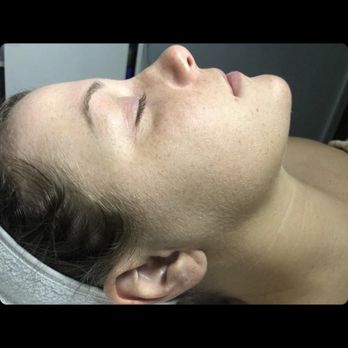 Pure Silk Beauty - Before dermaplaning - Eyelash Service Near Me - Columbus, Ohio