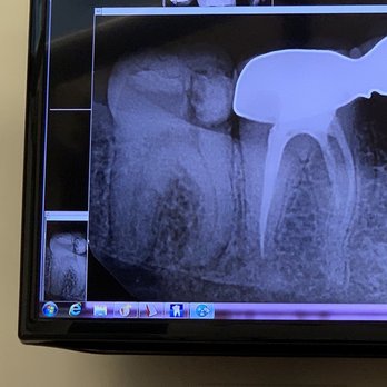 Kool Dentistry - Wisdom teeth - Cosmetic Dentists Near Me - Glendale, California Kool Dentistry - Wisdom teeth - Cosmetic Dentists Near Me - Glendale, California