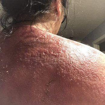 Integrative Health Centre - the rash I developed after seeing Chantelle - Traditional Chinese Medicine Near Me - Calgary, Alberta Integrative Health Centre - the rash I developed after seeing Chantelle - Traditional Chinese Medicine Near Me - Calgary, Alberta