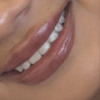 NakedMD - Day after the filler (and this is WITH lipgloss, which makes them look better) - Medical Spas Near Me - Burbank, California NakedMD - Day after the filler (and this is WITH lipgloss, which makes them look better) - Medical Spas Near Me - Burbank, California