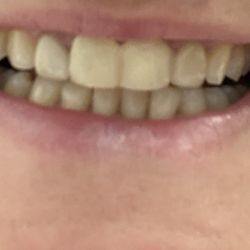 Comfort Dental - Fairwood - Denise's temporarily teeth