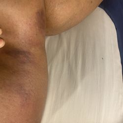 Texas Cardiology Associates of Houston - Bruises on my leg