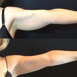 Ariya Aesthetics - Coolsculpting at Ariya Aesthetics