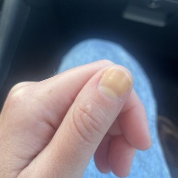 GG's Spa and Salon - Stained nail following polish removal - Hair Salons Near Me - Monterey,, California GG's Spa and Salon - Stained nail following polish removal - Hair Salons Near Me - Monterey,, California