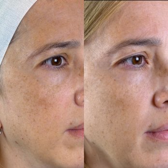 Tres Jolie - PicoFy Laser Treatment for Melasma - Laser Hair Removal Near Me - Chicago, Illinois Tres Jolie - PicoFy Laser Treatment for Melasma - Laser Hair Removal Near Me - Chicago, Illinois