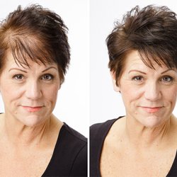 Prime Health UK - Hair Restoration Treatment - Before and After