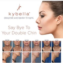 Shafer Clinic - Kybella is a non invasive way to melt your double chin