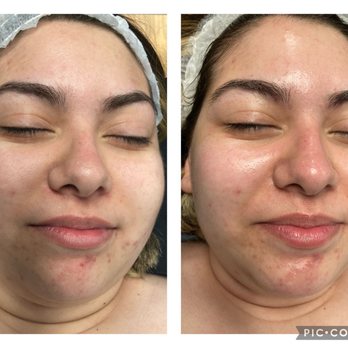 Marlenka Skin - Rosacea/ Acne facial - Skin Care Near Me - Riverside, California