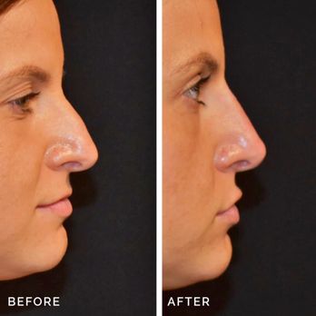 Skin MD - Nose filler, also known as non-surgical rhinoplasty or liquid rhinoplasty, uses dermal fillers to reshape the nose without surgery. - Medical Spas Near Me - Dedham, Massachusetts Skin MD - Nose filler, also known as non-surgical rhinoplasty or liquid rhinoplasty, uses dermal fillers to reshape the nose without surgery. - Medical Spas Near Me - Dedham, Massachusetts
