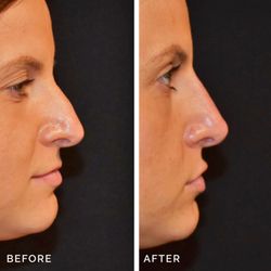 Nose filler, also known as non-surgical rhinoplasty or liquid rhinoplasty, uses dermal fillers to reshape the nose without surgery.