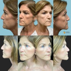 Suria Cosmetic Surgery & Medspa - Lower Face & Neck Lift