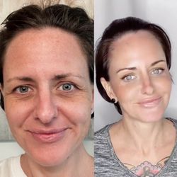 Hawaii Facial Plastic Surgery - One year ago: Immediate before and after. 42 years old and 42 years old.