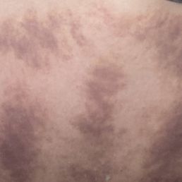 Gua sha, acupressure, Thai massage Gua sha, acupressure, Thai massage