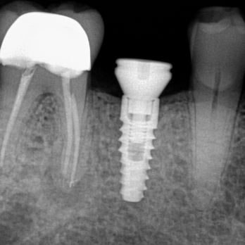 M&C Dental Services - Beautiful dental implant placement - Oral Surgeons Near Me - Miami, Florida M&C Dental Services - Beautiful dental implant placement - Oral Surgeons Near Me - Miami, Florida