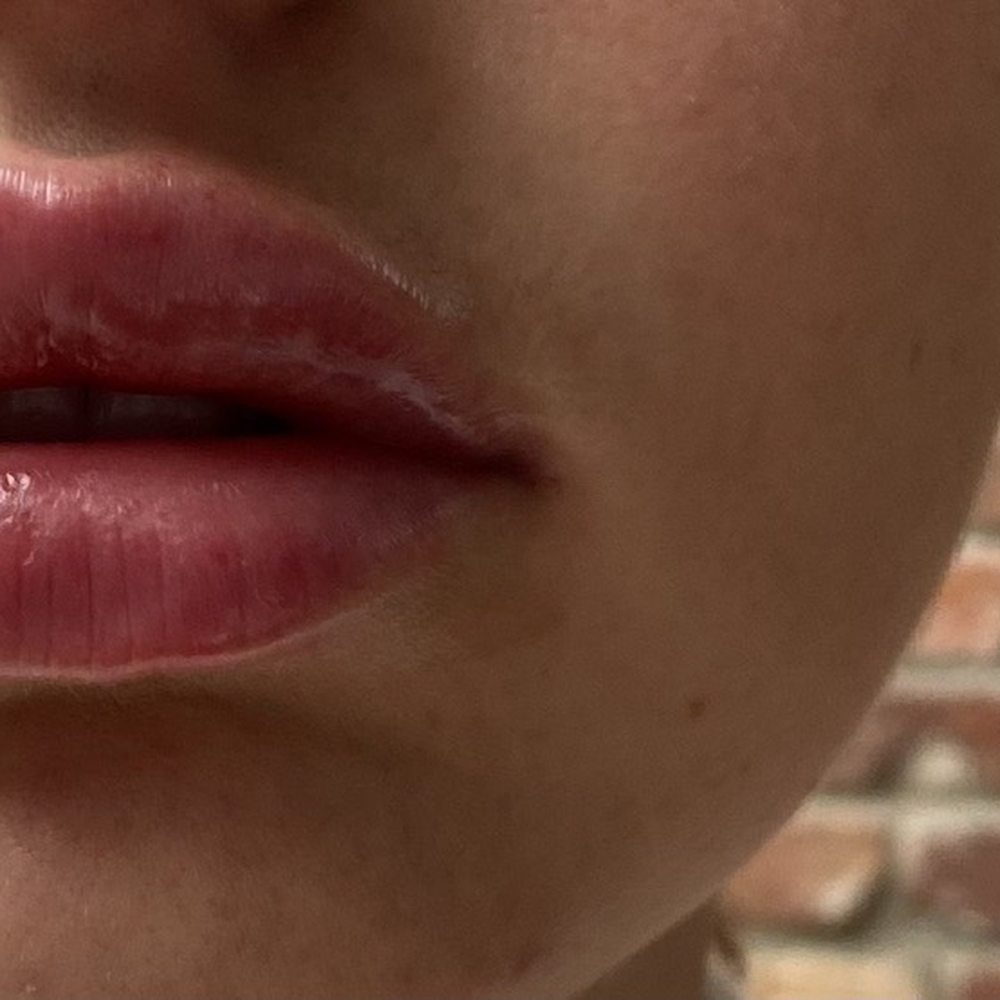 Manhattan Medspa - Lips less than 24 hours after injections - Medical Spas Near Me - New York, New York Manhattan Medspa - Lips less than 24 hours after injections - Medical Spas Near Me - New York, New York