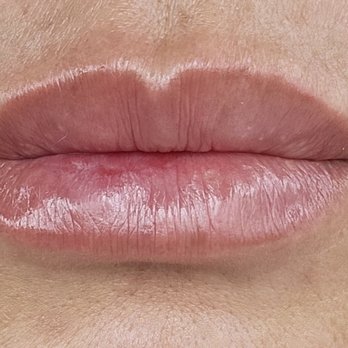 Heavenly Plastic Surgery - 0.5 Ml of filler - Plastic Surgeons Near Me - Lake Forest, California Heavenly Plastic Surgery - 0.5 Ml of filler - Plastic Surgeons Near Me - Lake Forest, California
