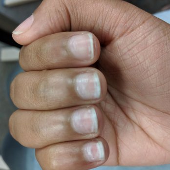 Lush Nails and Spa - Nails are removal shouldn't look like this - Nail Salons Near Me - Glassboro, New Jersey Lush Nails and Spa - Nails are removal shouldn't look like this - Nail Salons Near Me - Glassboro, New Jersey