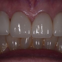Leatherwood Family and Cosmetic Dentistry - Porcelain Veneers and Crowns