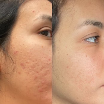 Daisy MD Care - Left picture taken January 1 2021/ right picture taken April 26 2021 - Skin Care Near Me - Downey, California