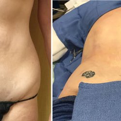 Norcal Liposculpture