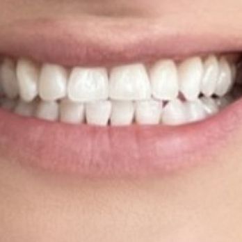 Viera Modern Dentistry - After teeth whitening with Dr.Mohammad - General Dentistry Near Me - Melbourne, Florida Viera Modern Dentistry - After teeth whitening with Dr.Mohammad - General Dentistry Near Me - Melbourne, Florida