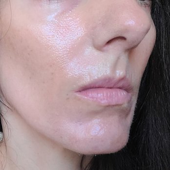LaserAway - 3 mo's after "Face Skin Resurfacing (+ neck)" I'm 46!!! ELASTICITY RETURNED!!! BUT ask for Resurfacing Numbing Cream.. painful w/o. - Medical Spas Near Me - West Hollywood, California LaserAway - 3 mo's after "Face Skin Resurfacing (+ neck)" I'm 46!!! ELASTICITY RETURNED!!! BUT ask for Resurfacing Numbing Cream.. painful w/o. - Medical Spas Near Me - West Hollywood, California