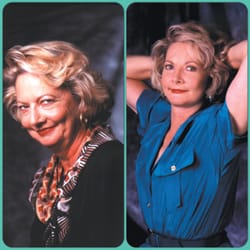 Del Mar Cosmetic Medical Center - Actual patient before and after - Complete Face Lift