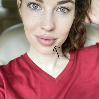Elite Rejuvenation - 2nd time lip filler - Done by Kimmy. Not symmetrical. Not happy. - IV Hydration Near Me - Boca Raton, Florida Elite Rejuvenation - 2nd time lip filler - Done by Kimmy. Not symmetrical. Not happy. - IV Hydration Near Me - Boca Raton, Florida