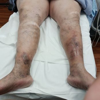 Advanced Surgical Care - Varicose veins with ulceration on both legs. - Surgeons Near Me - Reno, Nevada