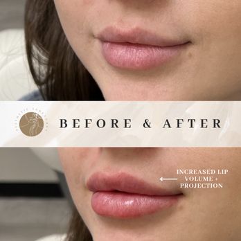 Aesthetic Sanctuary - Lip filler to increase lip volume and projection! - Medical Spas Near Me - Honolulu, Hawaii Aesthetic Sanctuary - Lip filler to increase lip volume and projection! - Medical Spas Near Me - Honolulu, Hawaii