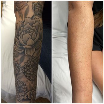 MEDermis Tattoo Removal - Before and after 10 laser treatments - Tattoo Removal Near Me - San Antonio, Texas MEDermis Tattoo Removal - Before and after 10 laser treatments - Tattoo Removal Near Me - San Antonio, Texas