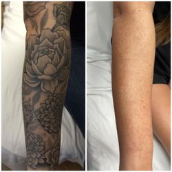 MEDermis Tattoo Removal - Before and after 10 laser treatments