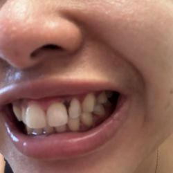 Accu Dental & Orthodontics - 6am morning bleeding blood gum. (Super rough deep cleaning by dentist there.) She said I know what I'm doing I'm a doctor.