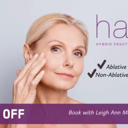 New-U Med Spa - Acne scarring
