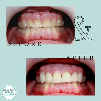 Healthy Smiles La Crescenta - Amazing smiles corrected with Porcelain Veneers! - General Dentistry Near Me - La Crescenta, California Healthy Smiles La Crescenta - Amazing smiles corrected with Porcelain Veneers! - General Dentistry Near Me - La Crescenta, California