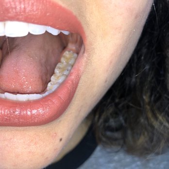 Joy Dental - After cavity filled - Cosmetic Dentists Near Me - Tijuana, BCN