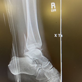 Northern Inyo Hospital - Fractured ankle - Hospitals Near Me - Bishop, California Northern Inyo Hospital - Fractured ankle - Hospitals Near Me - Bishop, California