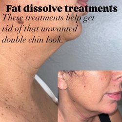 Sheer Beauty By Z - Fat dissolve and body sculpting treatments under the chin can get rid of that double chin look.